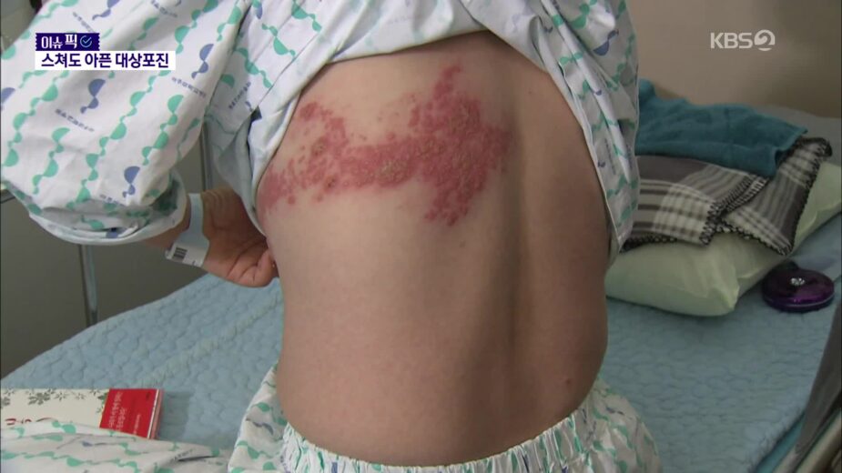 Shingles rash on a patient’s back